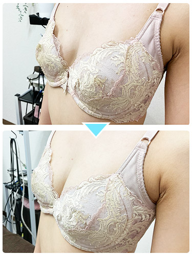 バストアップ施術事例7 バストアップ施術事例7