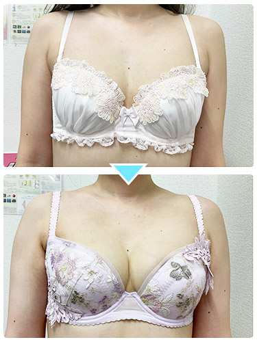 バストアップ施術事例2 バストアップ施術事例2