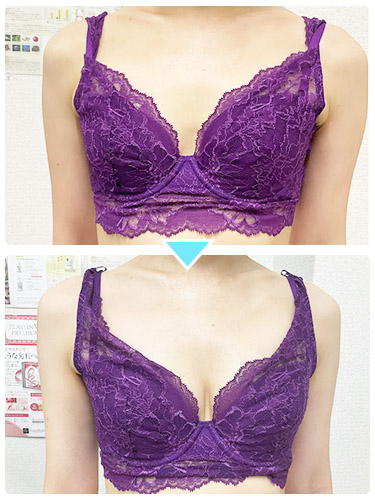 バストアップ施術事例3 バストアップ施術事例3