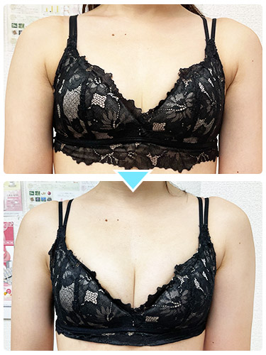 バストアップ施術事例4 バストアップ施術事例4