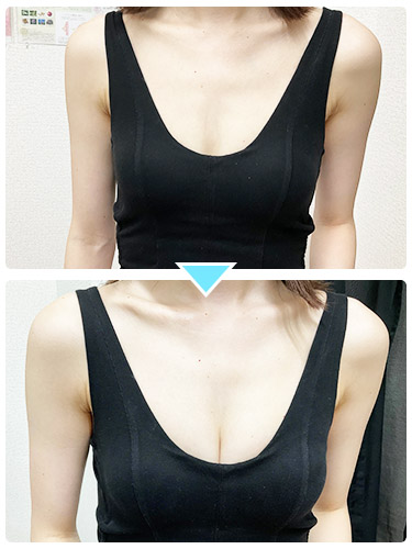 バストアップ施術事例5 バストアップ施術事例5