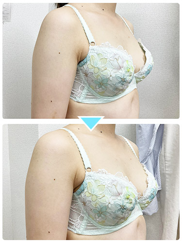 バストアップ施術事例6 バストアップ施術事例6