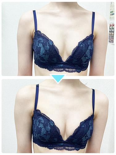 バストアップ施術事例8 バストアップ施術事例8