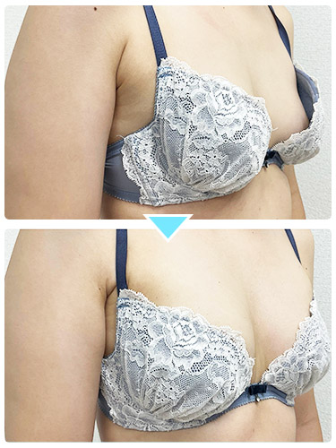 バストアップ施術事例9 バストアップ施術事例9